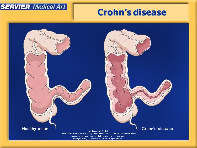 Crohn’s disease Healthy colon Crohn’s disease